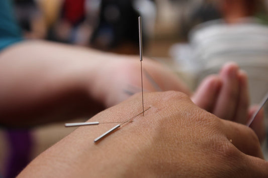 Point acupuncture sommeil